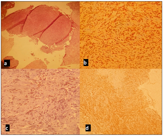 Microscopic images: (a) Undifferentiated tumor proliferation; (b) Anti-Ki67 antibody diffusely labeling tumor cells; (c) Anti-OCT4 antibody focal nuclear positivity of tumor cells; (d) Anti-EMA antibody x100 positive on tumor cells.