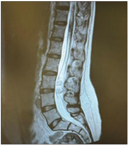 T2 lumbar MRI showing a subdural lesion regarding L3-L4 compressing the cauda equina roots.