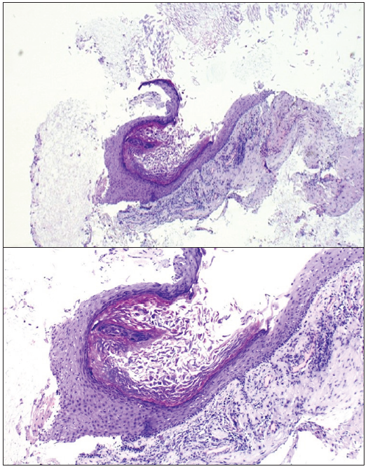 Pathological image showing an epidermoid cyst, bordered by a keratinizing squamous epithelium without atypia, subtended by a fibroinflammatory stroma containing a few vessels with no sign of malignancy.