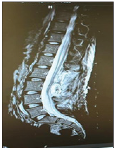 Postoperative lumbar MRI showing a collection of posterior to the surgical site extending from L2 to L5, approximately 50*20 mm in the axial plane and 10 cm in height, non-compressive on the ponytail roots.