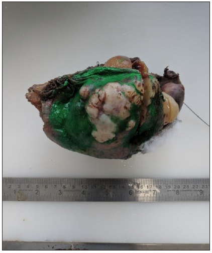 Chondrosarcoma rib.