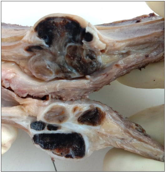 Clear cell sarcoma rib.