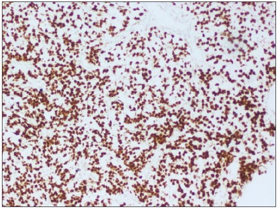 Diffuse strong nuclear staining of BCOR, 100x.