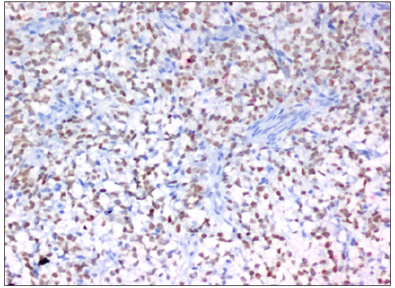Strong nuclear staining of SATB2, 200x. SATB2: Special AT-rich sequence-binding protein 2.
