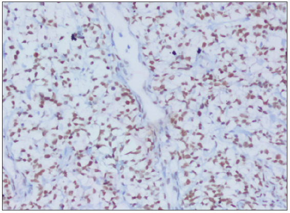 Strong nuclear staining of TLE1, 200x. TLE1: Transducin-Like enhancer of split-1.