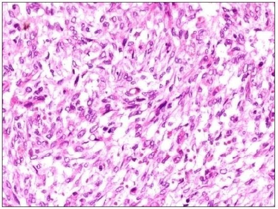 Primary Renal BCOR sarcoma: Primary visceral (renal) BCOR sarcoma with predominant spindle cell morphology, H&E, 200x.