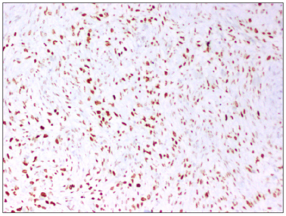 Moderate to intense staining for BCOR in >10% of tumor cells, 100x.