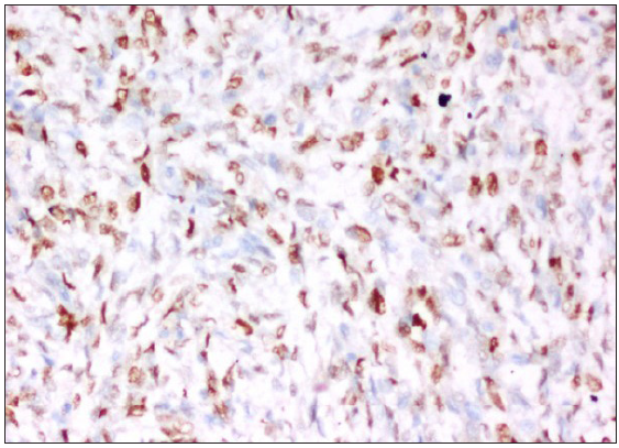 Moderate to intense staining of CyclinD1, 200x.