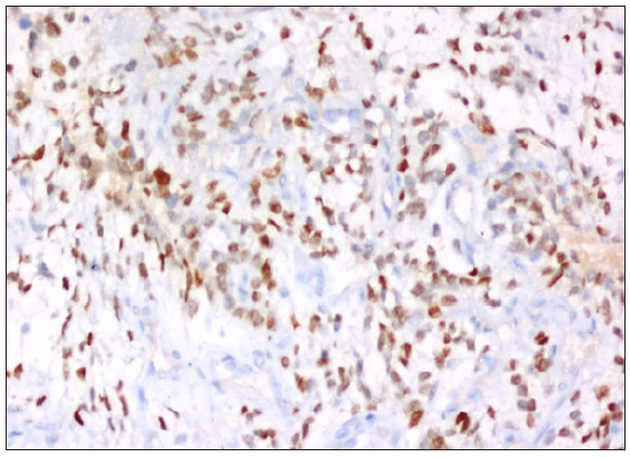 Moderate to intense staining of SATB2, 200x, SATB2: Special AT-rich sequence-binding protein 2.
