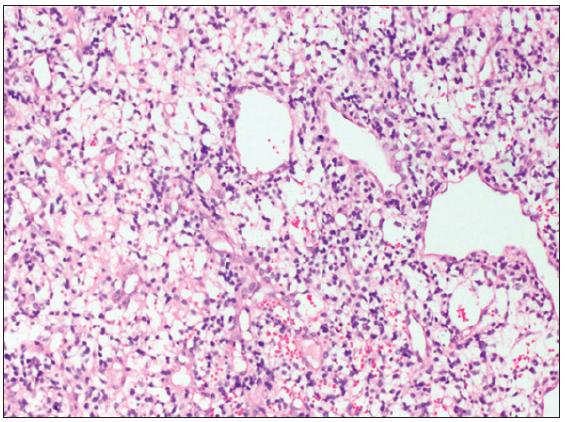 Primitive myxoid mesenchymal tumor infancy, neck. Myxoid to edematous stroma and conspicuous vasculature, (Hematoxylin and eosin, 100x).