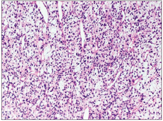 Primitive myxoid mesenchymal tumor of Infancy, neck. Myxoid to edematous stroma and conspicuous vasculature, (Hematoxylin and eosin, 100x)