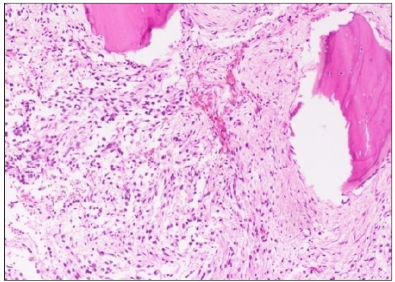BCOR-CCNB3 positive sarcoma – calcaneum: BCOR sarcoma of bone with spindle and round cells in a myxoid stroma, Hematoxylin and eosin, 100x.