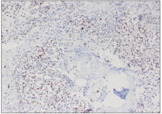 Moderate to intense nuclear staining in >10% of tumor cells, BCOR, 100x.