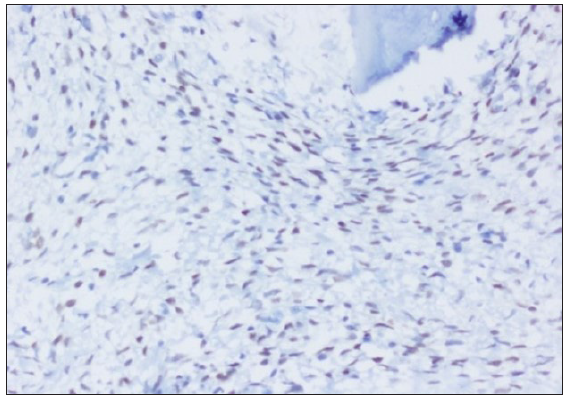 Moderate to intense nuclear staining of tumor cells, SATB2, 200x.