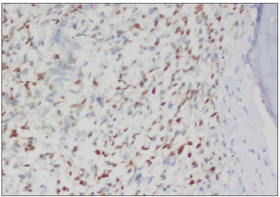 Moderate to intense nuclear staining of tumor cells, CyclinD1, 200x.