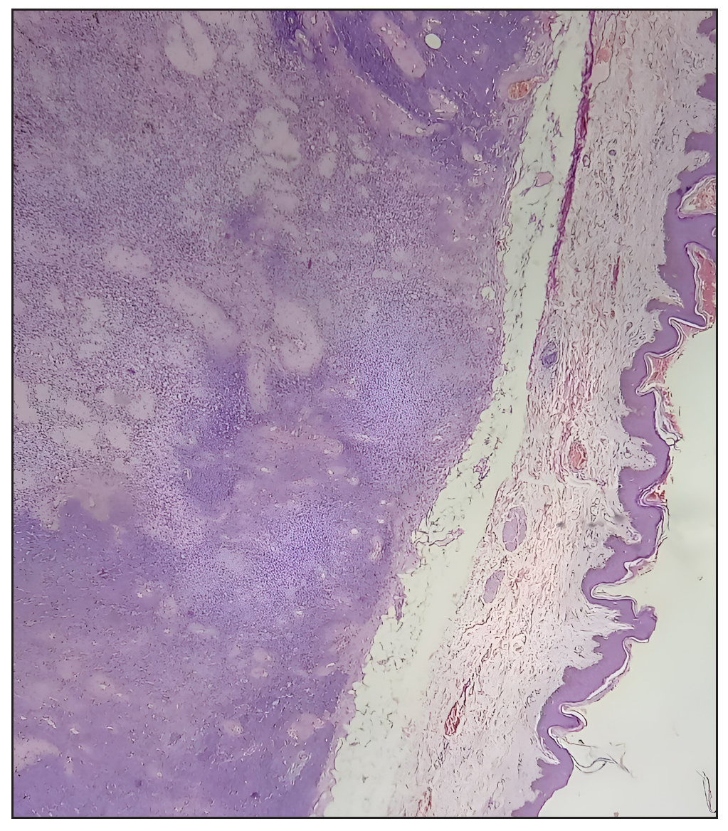 Low-power photomicrograph demonstrating the tumor’s well-demarcated border (Hematoxylin and Eosin, 100x).