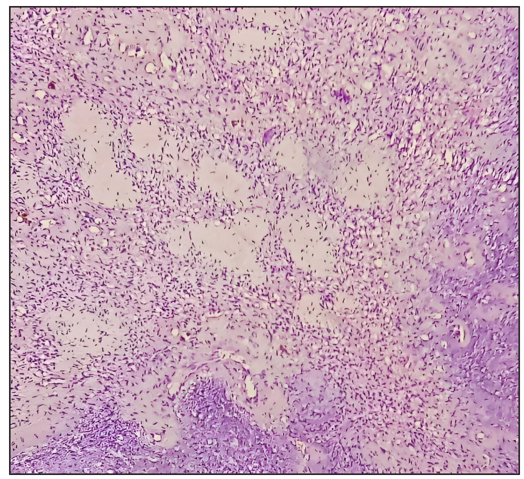 Low-power photomicrograph highlighting capillary proliferation within the lesion (Hematoxylin and Eosin, 100x).