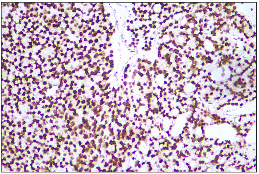 TTF1 positive follicular area (Immunohistochemistry stain, 40x). TTF1: Thyroid transcription factor 1.