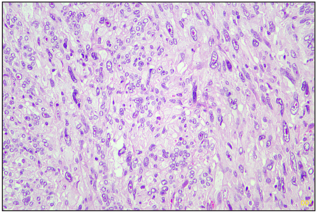 Sarcomatous area (Hematoxylin and eosin, 20x).