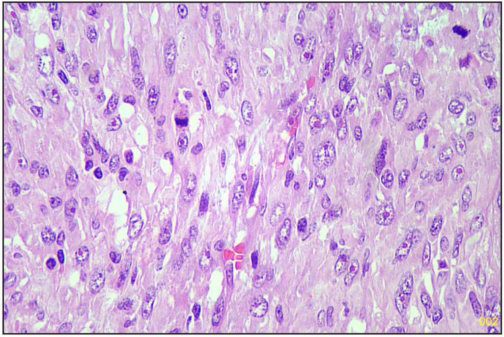 Sarcomatous area (Hematoxylin and eosin, 40x).