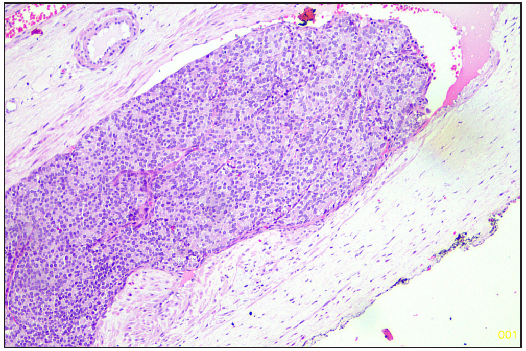 Lymphovascular emboli (Hematoxylin and eosin, 20x).