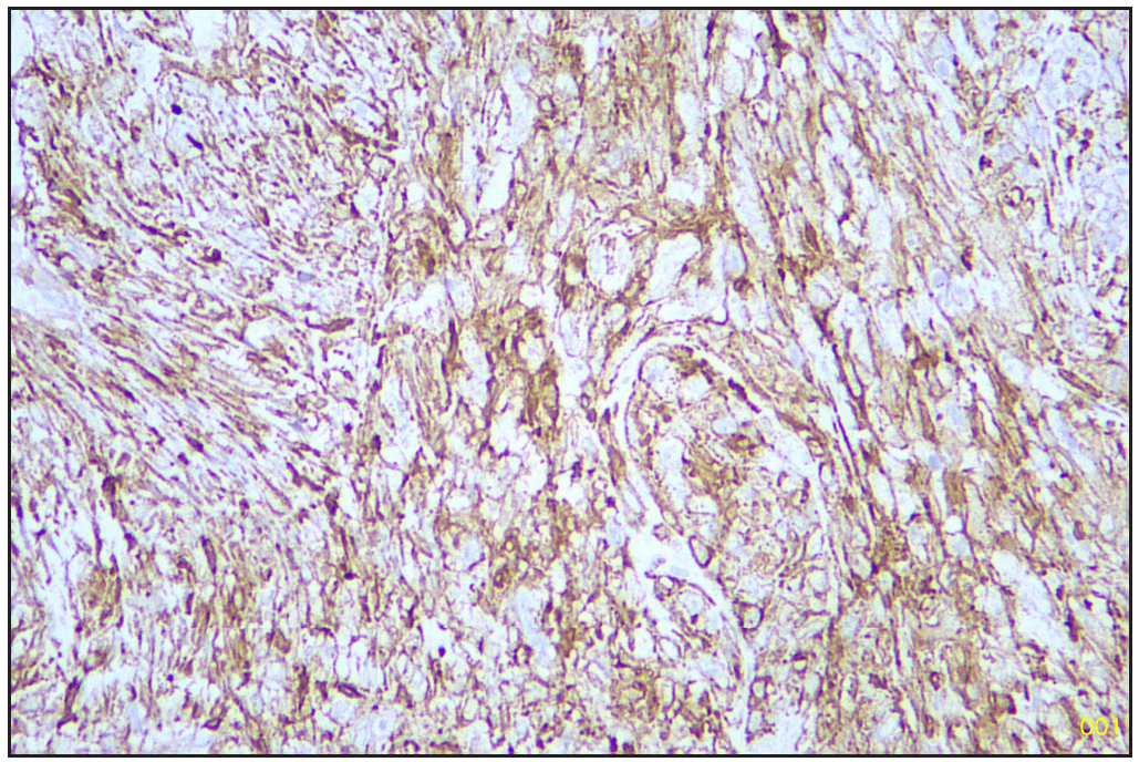 SMA positive sarcomatous area (Immunohistochemistry stain, 40x). SMA: Smooth muscle actin.