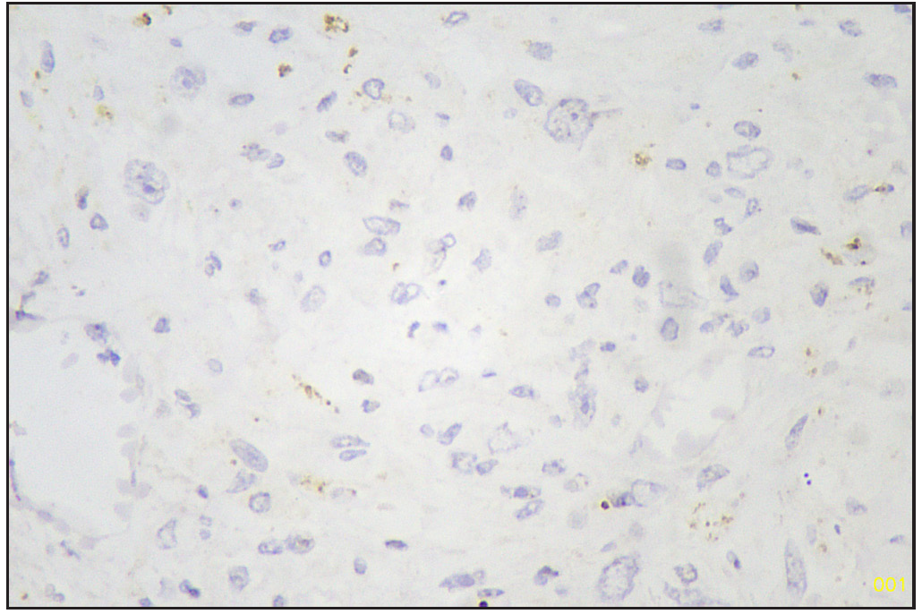 Pan CK negative sarcomatous area (Immunohistochemistry stain, 40x). CK: Pan-cytokeratin.