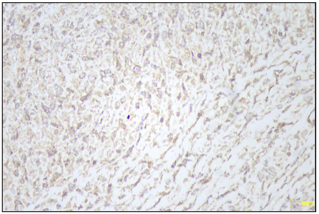 Pax8 negative sarcomatous area (Immunohistochemistry stain, 40x).