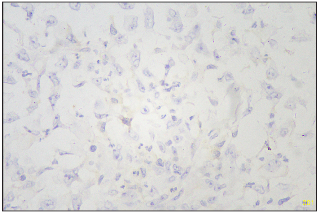 SOX10 negative sarcomatous area (Immunohistochemistry stain, 40x). SOX10: Sry-related HMg-Box gene 10.